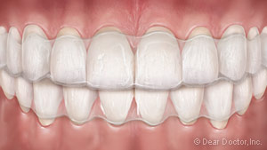 Clear aligners graphic