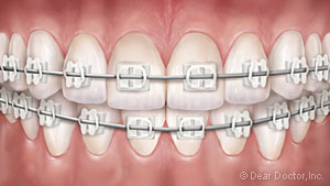Clear braces graphic