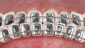 Lingual braces graphic