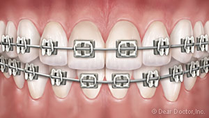 Metal braces graphic