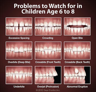 Examples of orthodontic problems in children